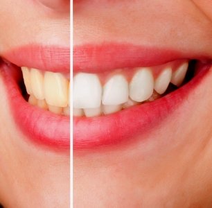 Teeth Whitening in Pune