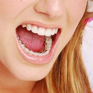 Invisible Braces Pune Lingual braces Bespoke Dental