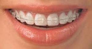 Ceramic Braces in Pune, orthodontist in Pune, Orthodontist in Magarpatta, Orthodontist in Amanora, orthodontist in kharadi, orthodontist in sopan baug, orthodontist in wanowrie, orthodontist in koregaon park, orthodontist in NIBM, orthodontist in Kondhwa, orthodontist in wagholi, orhtodontist in chandan nagar, orthodontist in viman nagar, orthodontist in kalyaninagar, orthodontist in baramati