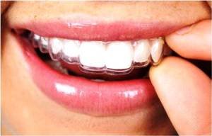 Invisible Braces in Pune