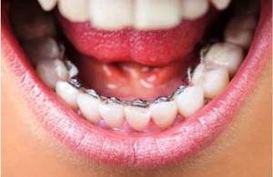 Lingual braces in Pune, Invisible braces in Pune
