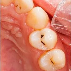 Cavity Fillings in Pune