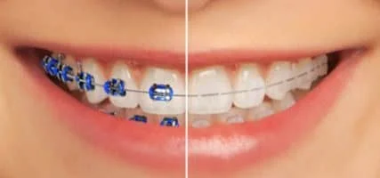 Orthodontic Braces in Pune