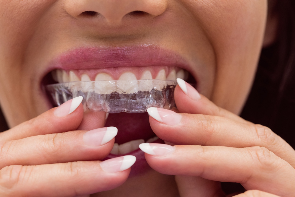 Invisible Braces treatment In Pune