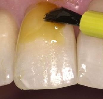 Pediatric Dentistry in Pune