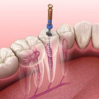 Procedure Of Root Canal In Pune
