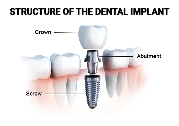 Structure Of Dental Implants in Pune