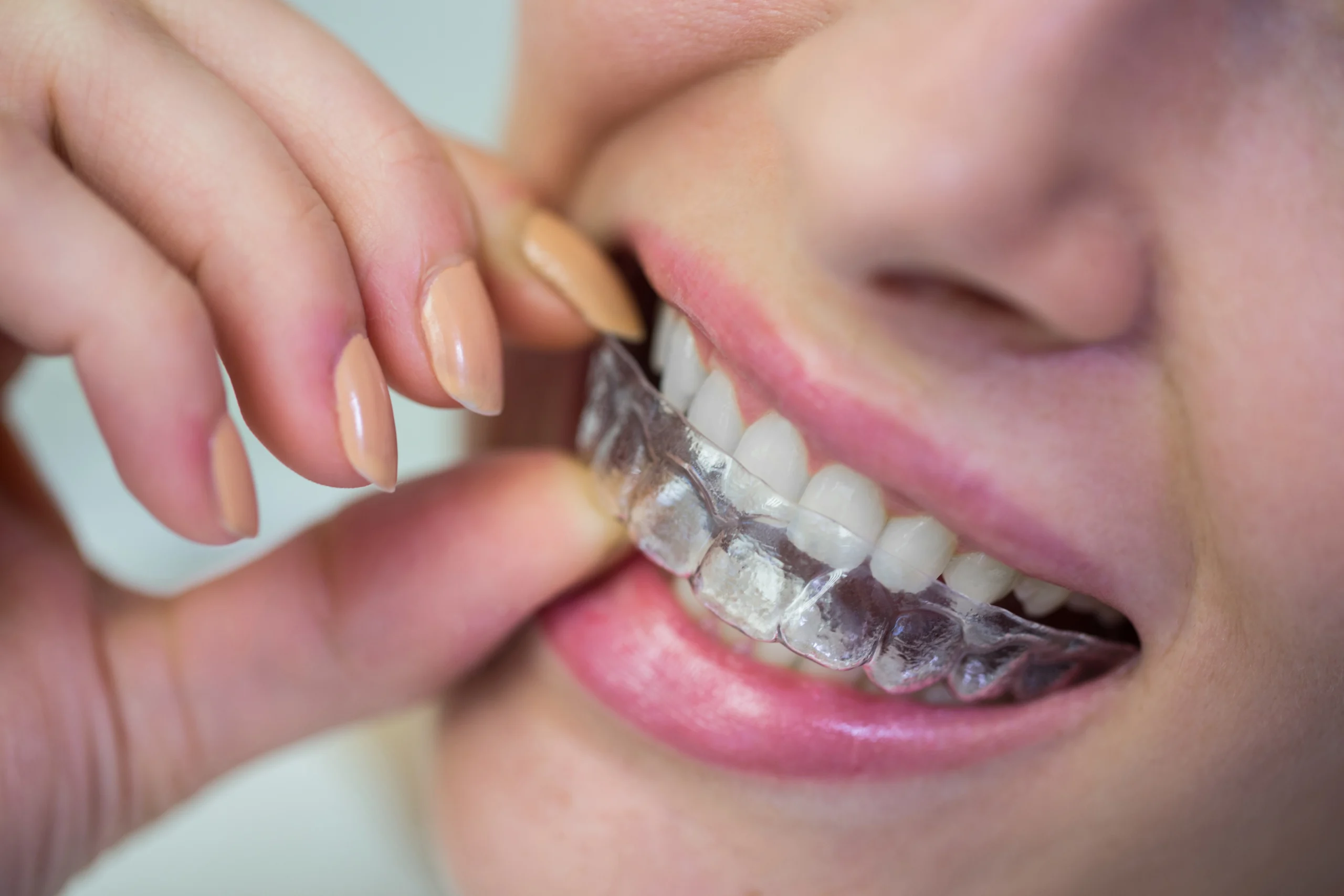 Invisible Braces in Pune