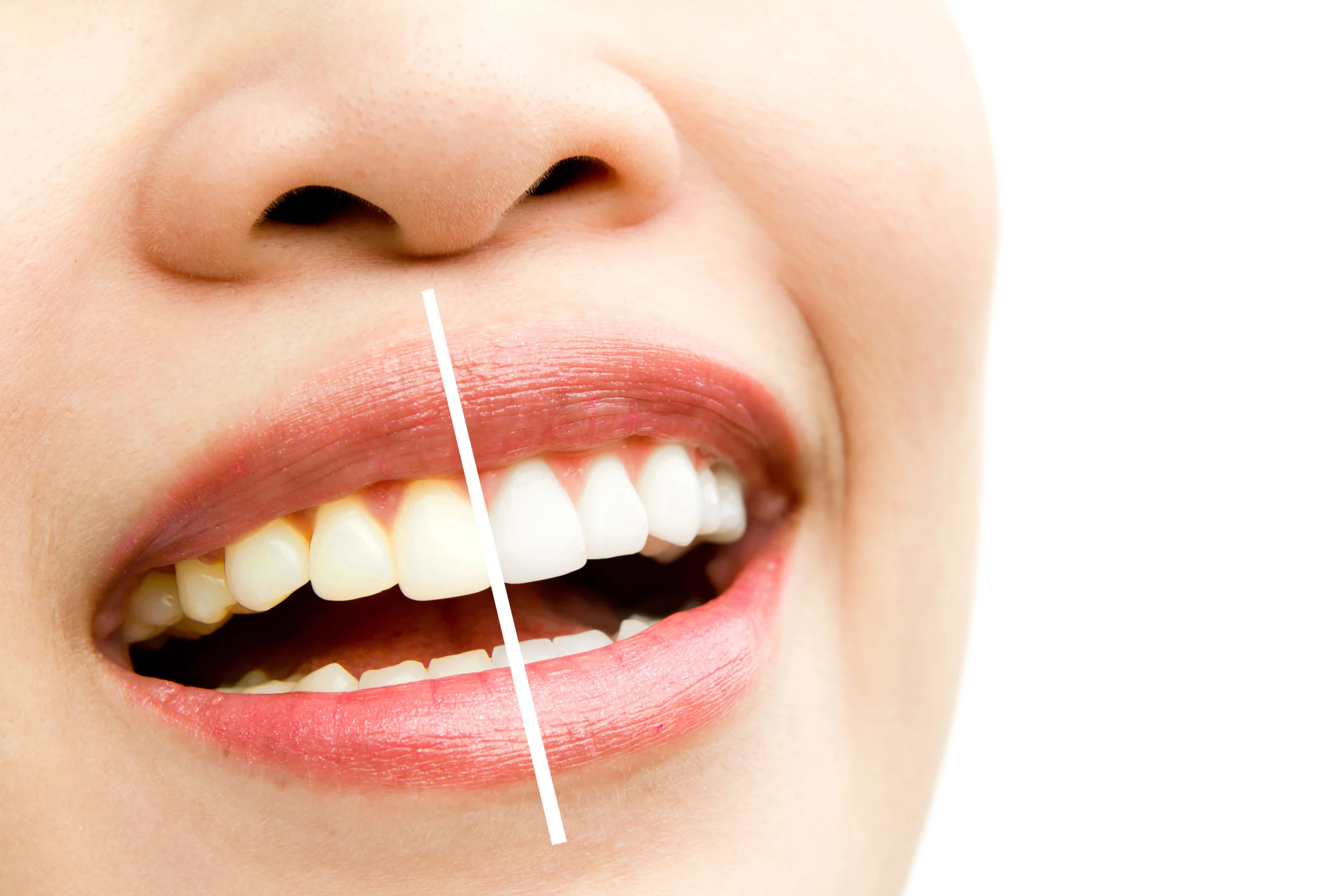 Teeth Whitening in Pune